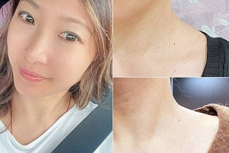 台北除疣│除肉芽│除小息肉│鉺雅鉻雷射除疣，告別髒脖子輕鬆完勝顆粒肌│旭彤診所-台北除疣推薦