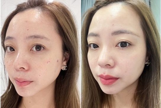 有結痂的皮秒雷射：找回水煮蛋肌｜台中仲夏美形-變美找安英總監