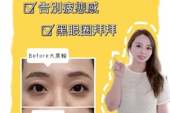 告別黑眼圈-膠原蛋白熊貓針｜台中仲夏美形診所-變美找安英總監