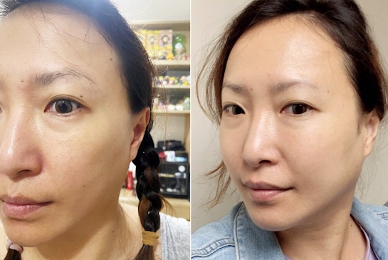 台北東區打雷射｜RedTouch PRO凍態雷射(果凍光)療程分享+成果，推薦膠原蛋白的神祕救援手│台北打雷射醫美推薦綻妍診所