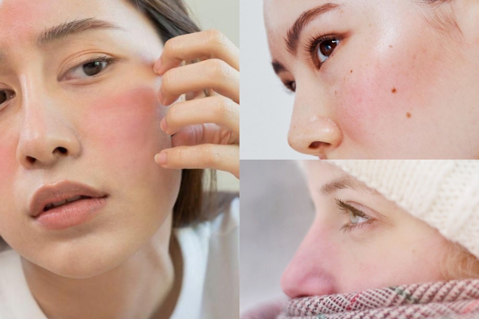 為什麼冬天總是臉紅紅？10個導致臉部泛紅的冬季刺激來源：室內外溫差大、洗臉水溫過高、疊擦過多保養品⋯都會讓皮膚更敏感！